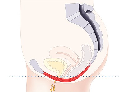 Pelvic-Floor Muscle Repair 5 Pelvic floor muscles Edinburgh