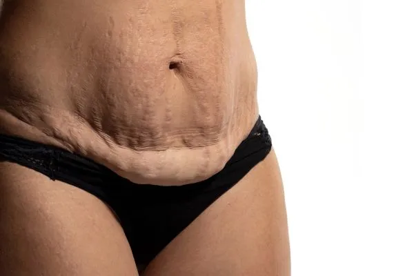 The science behind skin tightening Edinburgh picture of a woman's sagging skin on the stomach